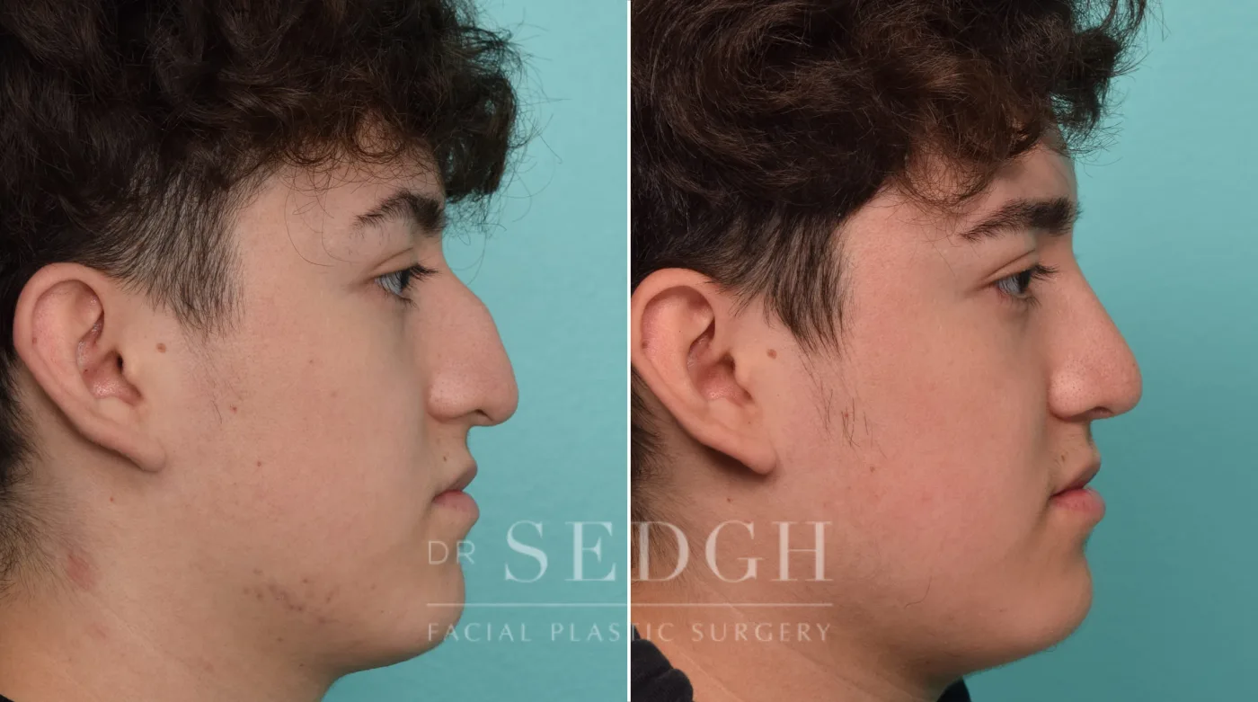 Patient 296 after Rhinoplasty, view 1