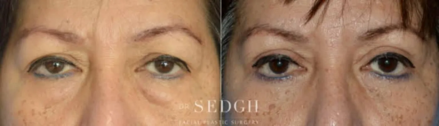 Patient 6 before Upper Blepharoplasty, view 1