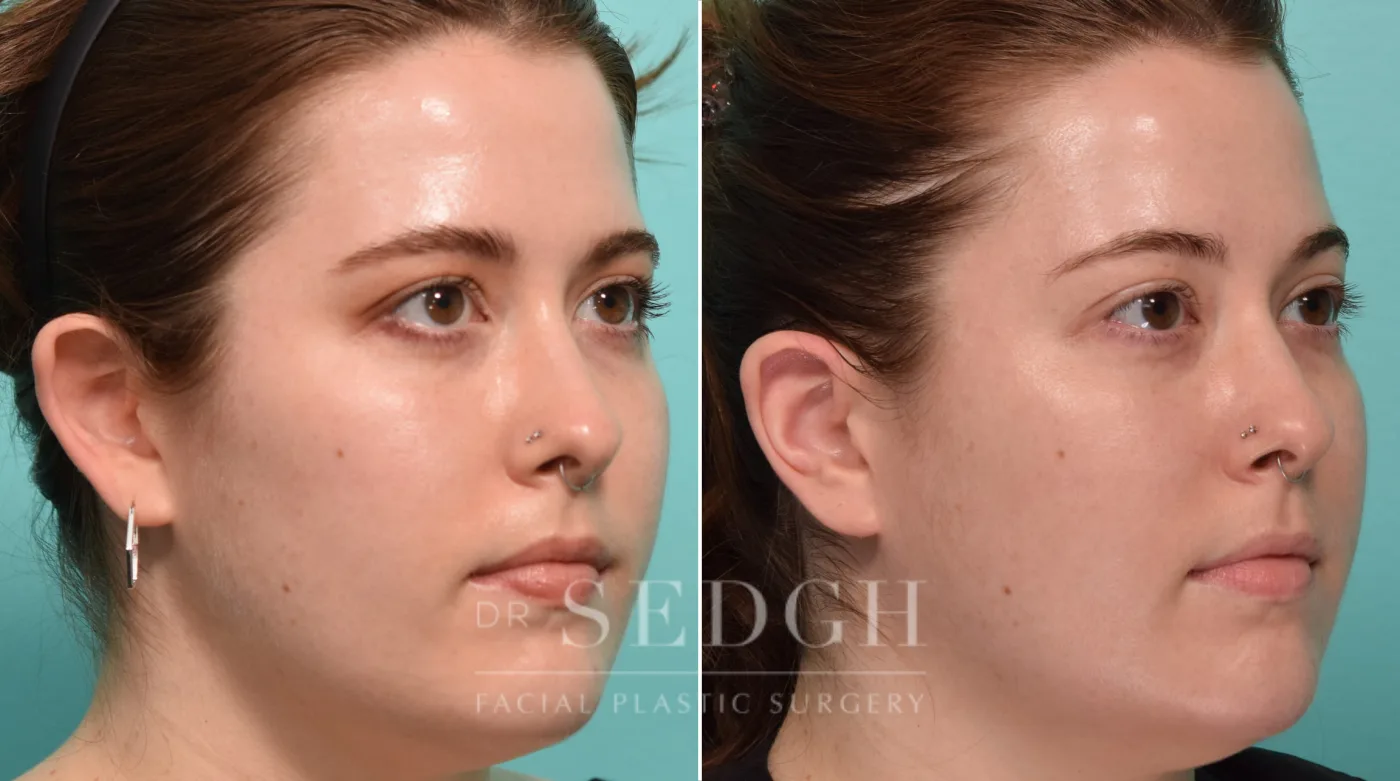 Patient 269 before Ear Pinning Surgery, view 2