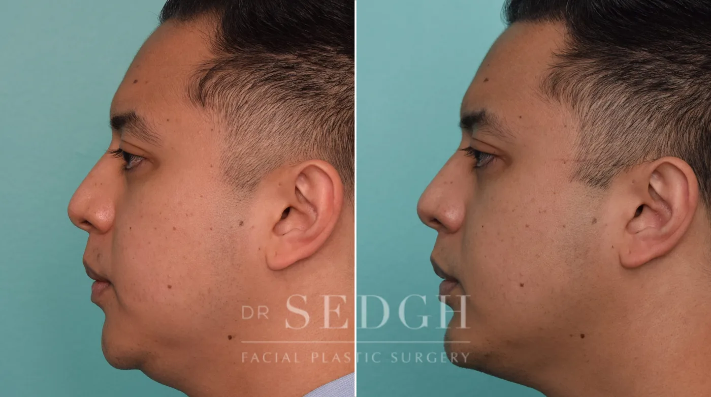Patient 278 after Chin Augmentation, view 1