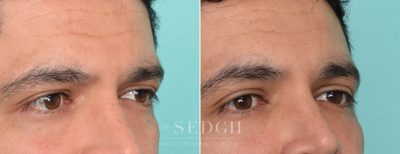 Patient 302 before Lower Blepharoplasty, view 1