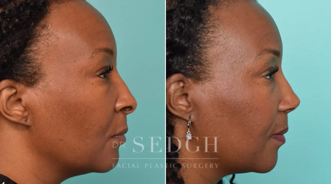 Patient 246 after African American Rhinoplasty, view 2