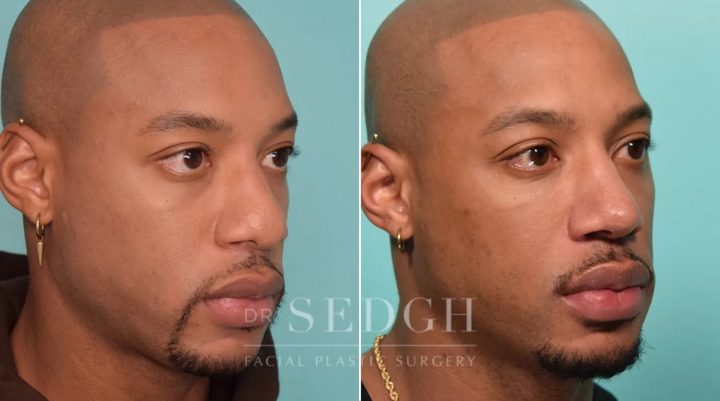 Patient 22 before Male Rhinoplasty, view 2