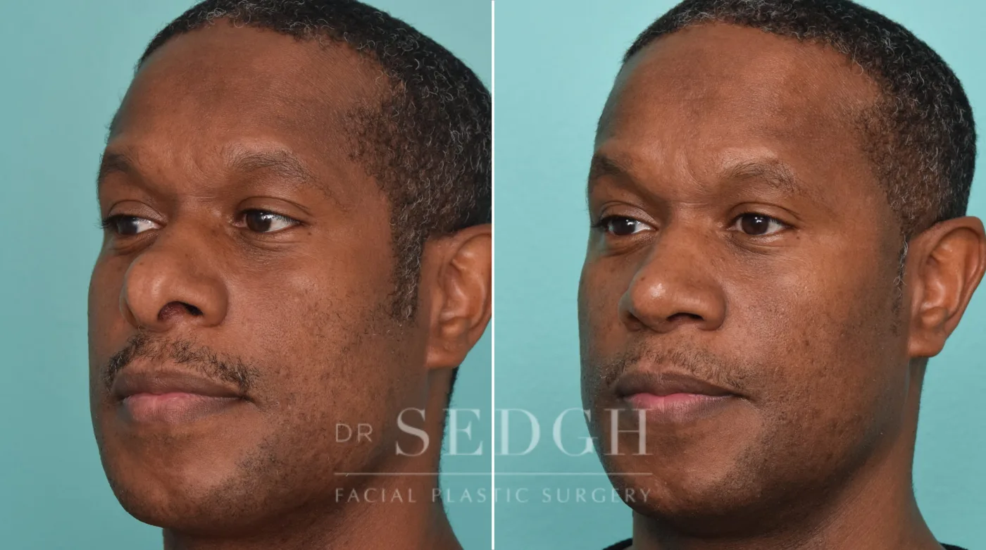 Patient 272 before African American Rhinoplasty, view 1
