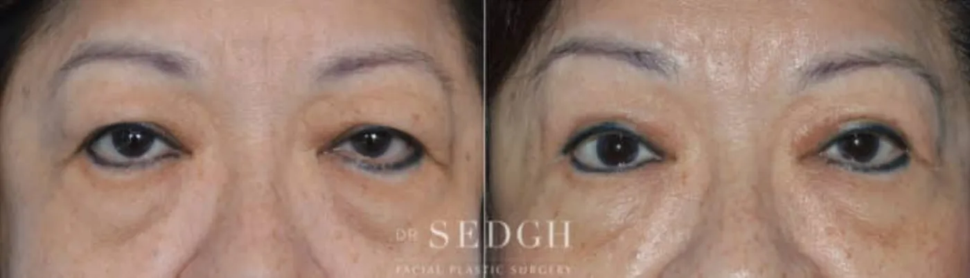Patient 7 before Brow Lift, view 1