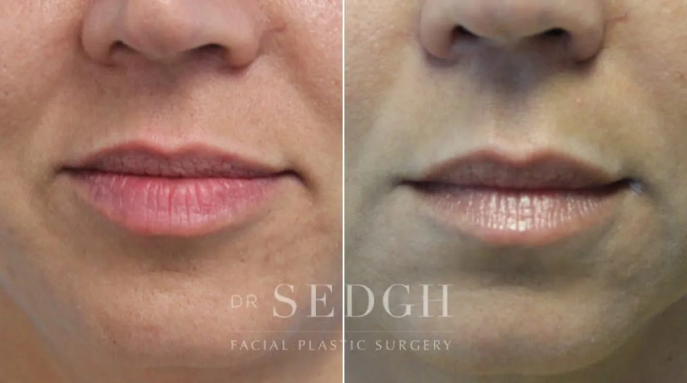 Patient 2 after lip augmentation, view 1
