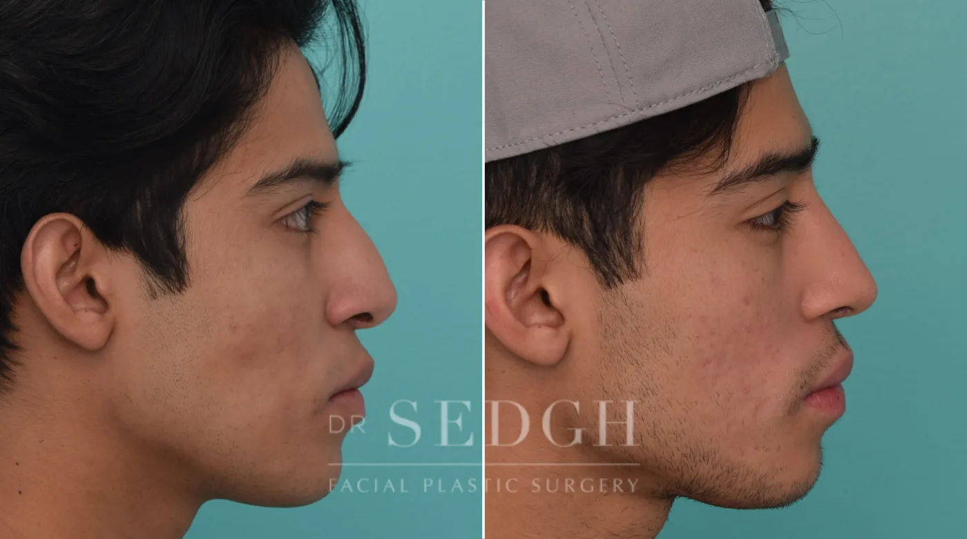 Patient 201 after Revision Rhinoplasty, view 1
