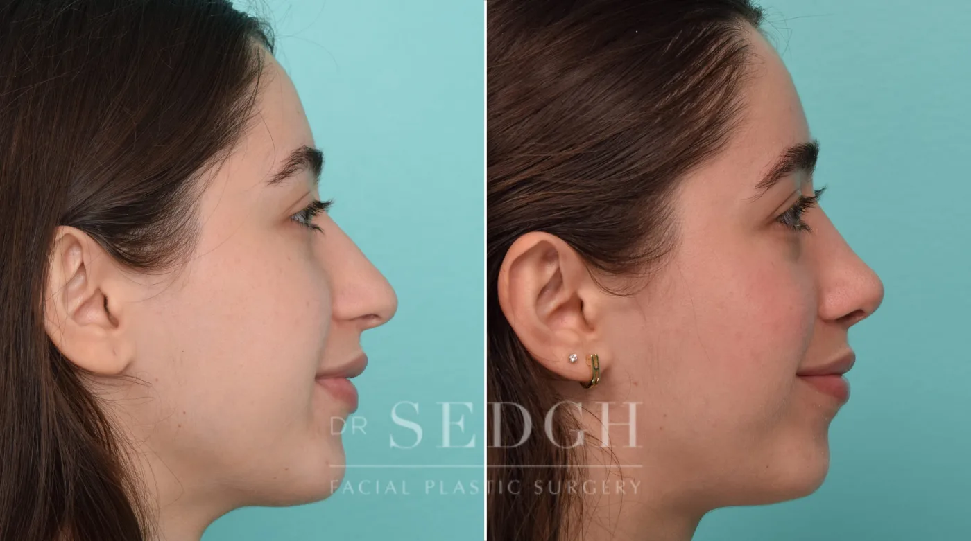 Patient 290 after Crooked Nose Surgery, view 1