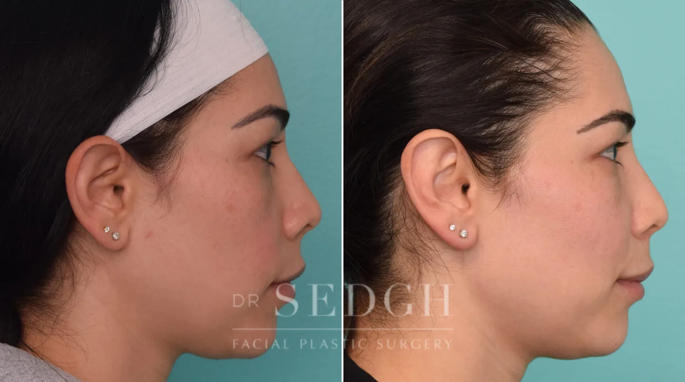 Patient 258 after Ear Pinning Surgery, view 2
