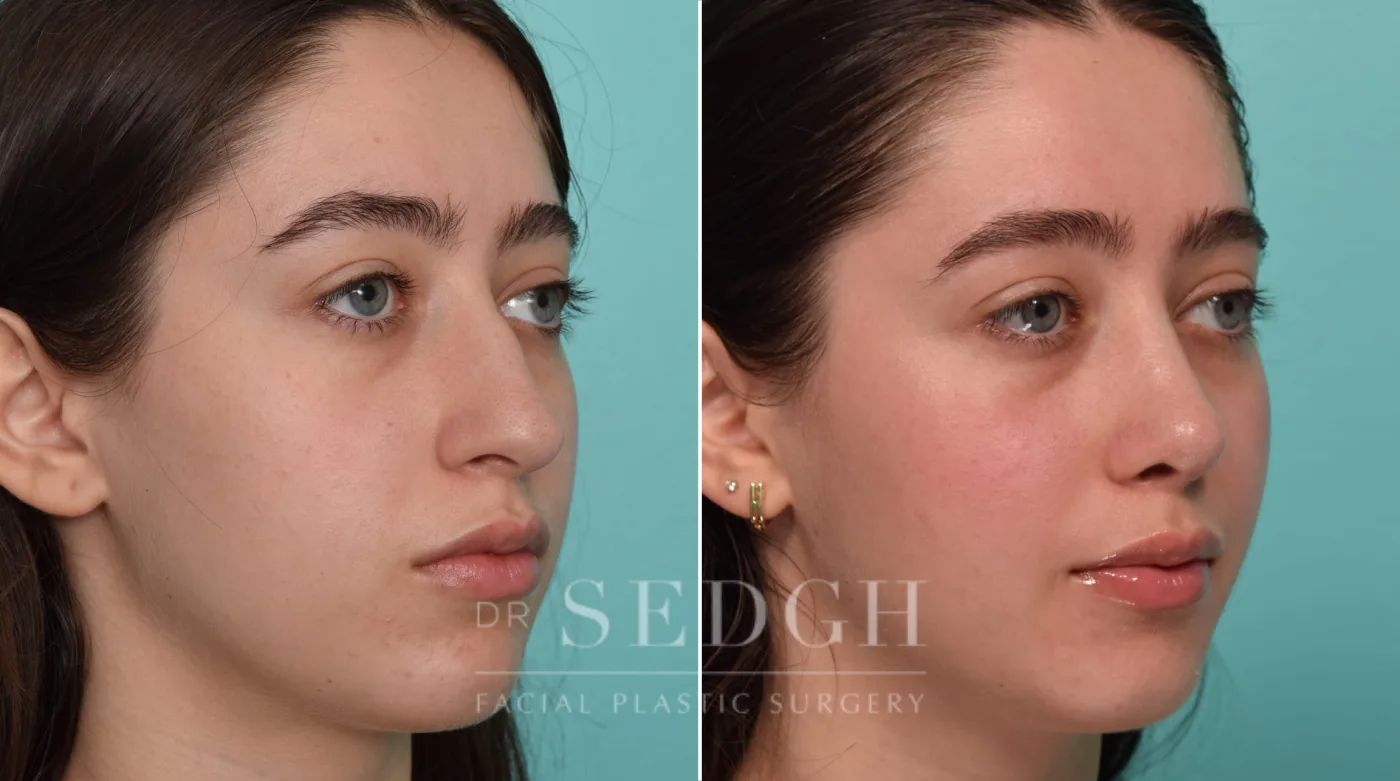 Patient 290 before Crooked Nose Surgery, view 1