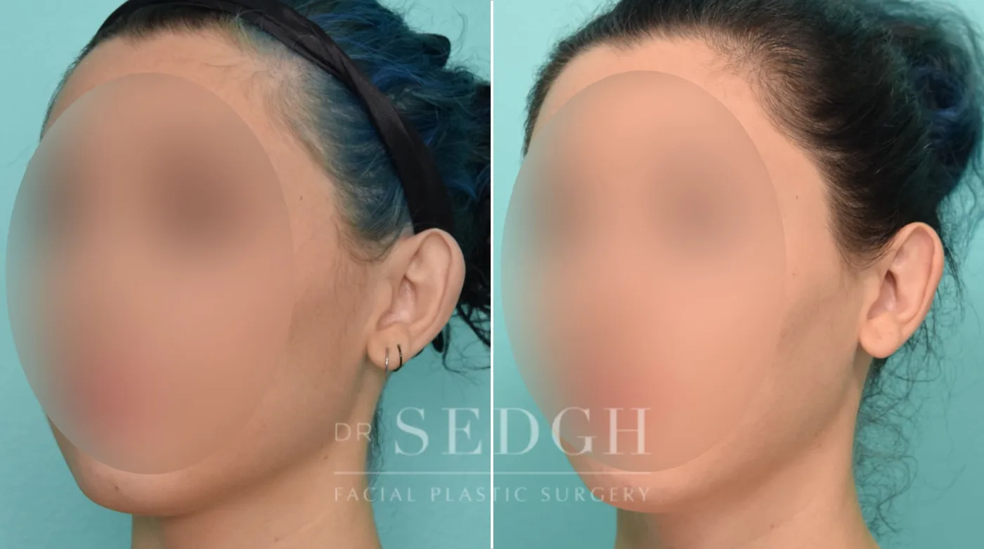 Patient 267 before Ear Pinning Surgery, view 1