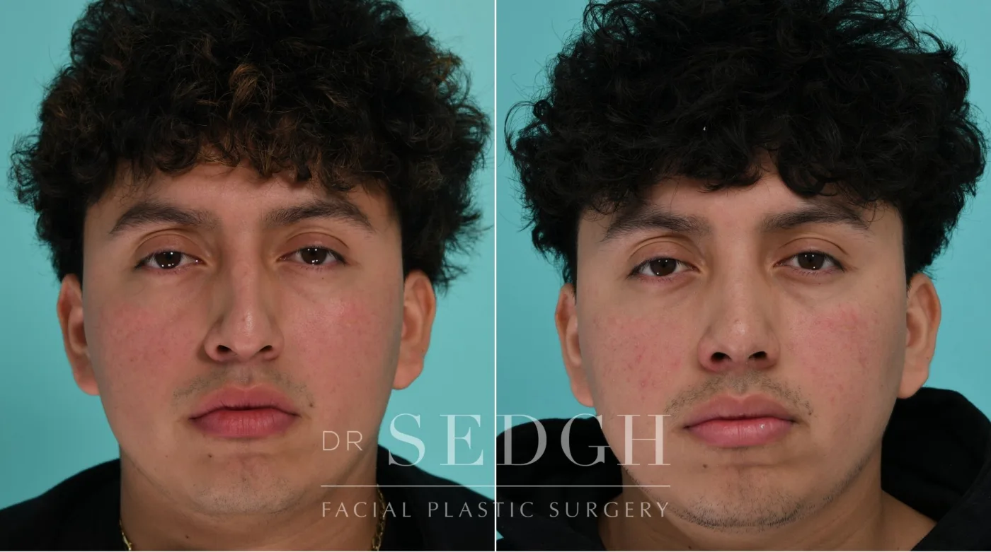 Patient 339 before Male Rhinoplasty, view 3