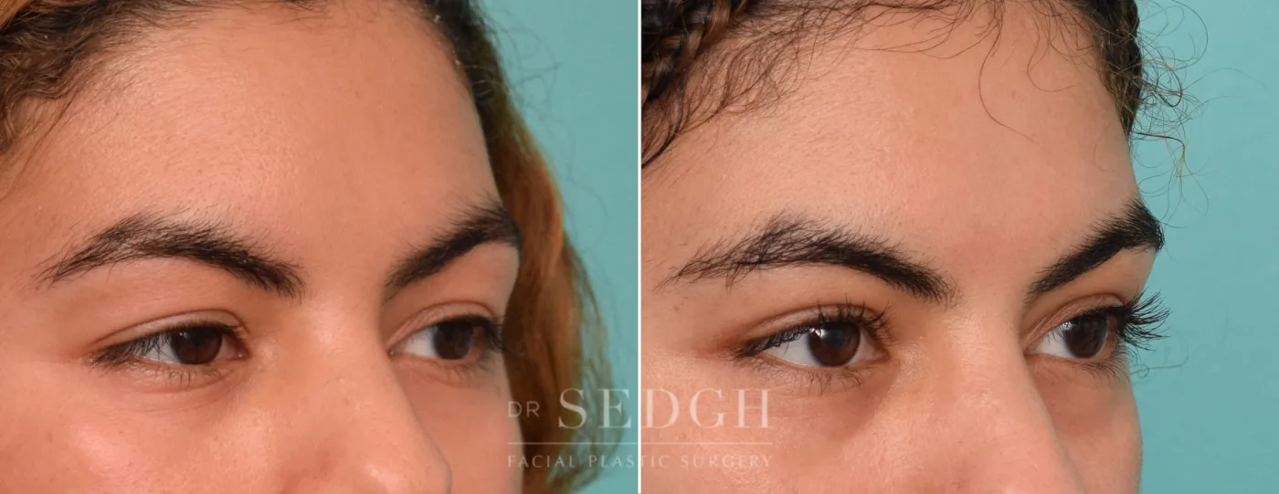 Patient 300 before Upper Blepharoplasty, view 1