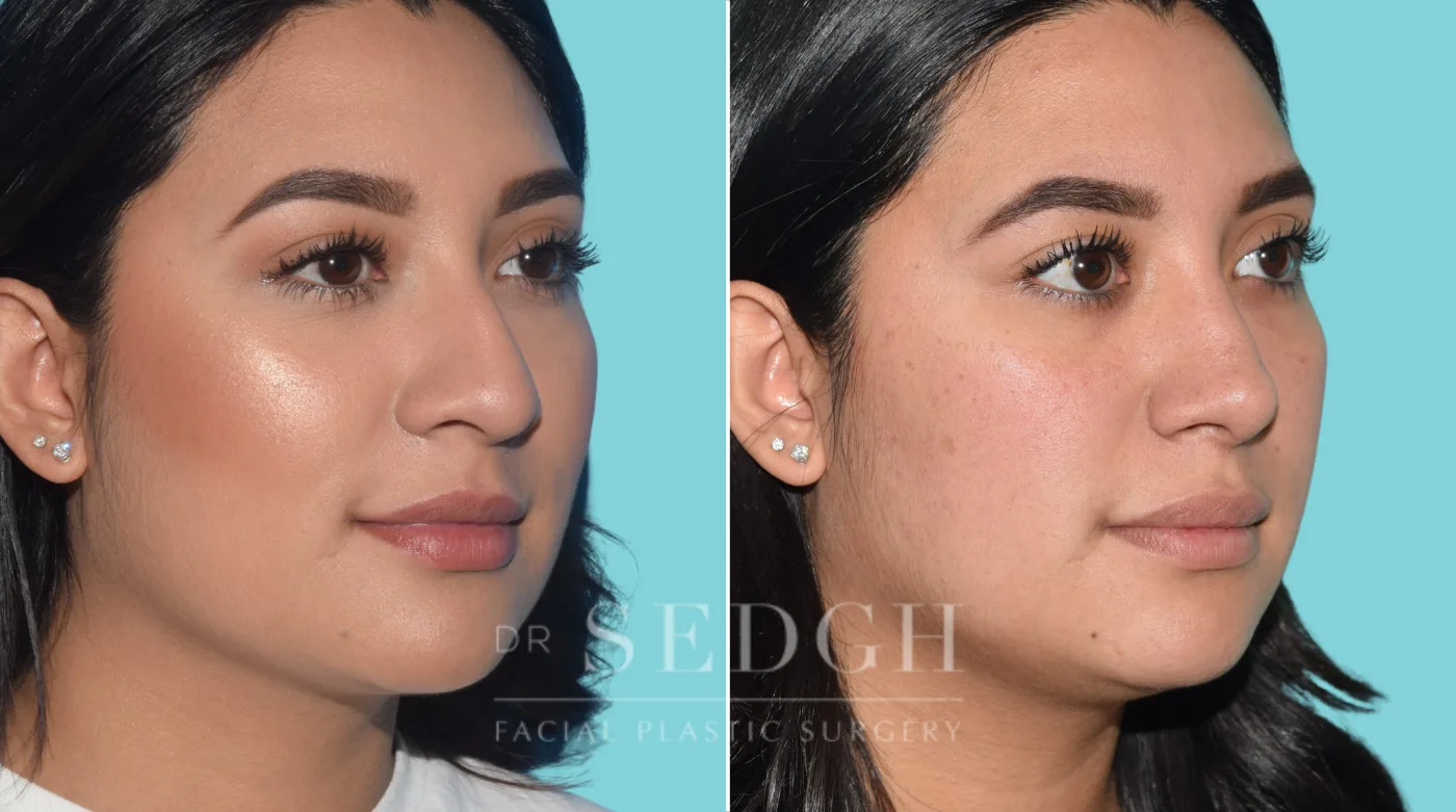 Patient 34 before Rhinoplasty, view 2