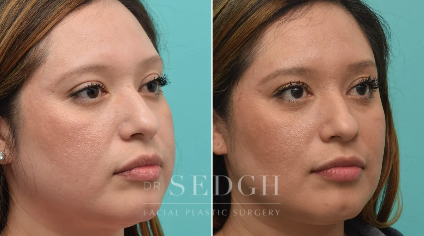 Patient 240 before Buccal Fat Reduction, view 1