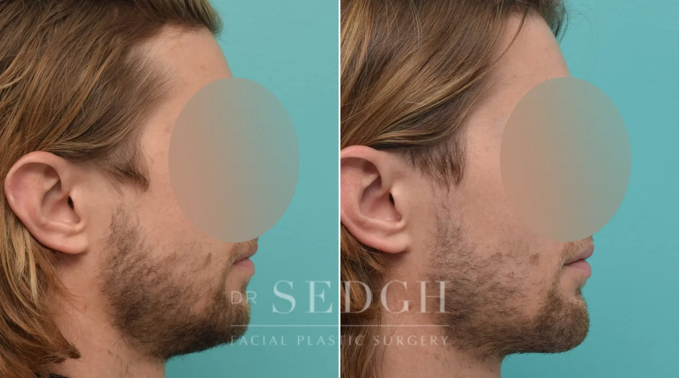 Patient 146 after Chin Augmentation, view 1