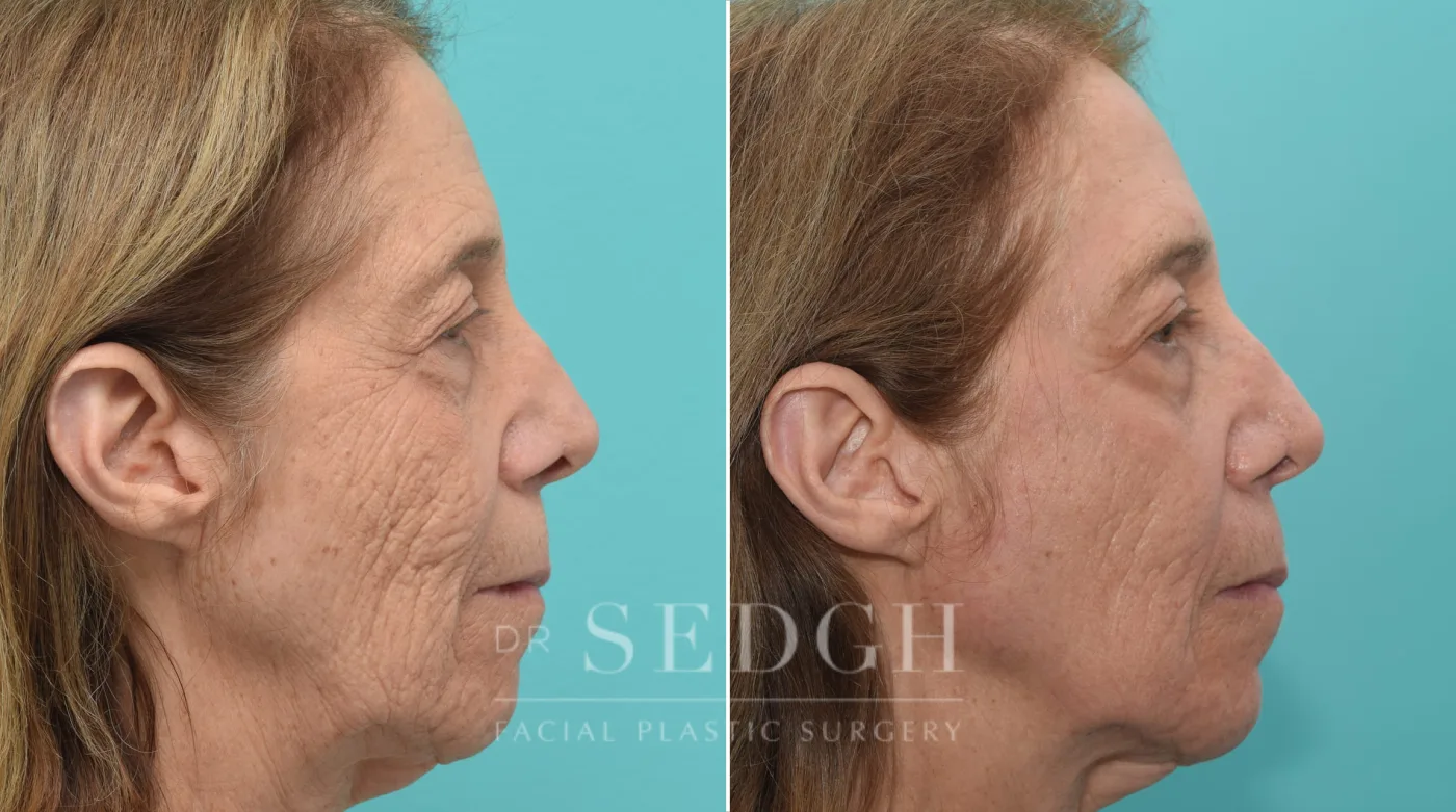 Patient 149 after Laser Skin Treatments, view 1