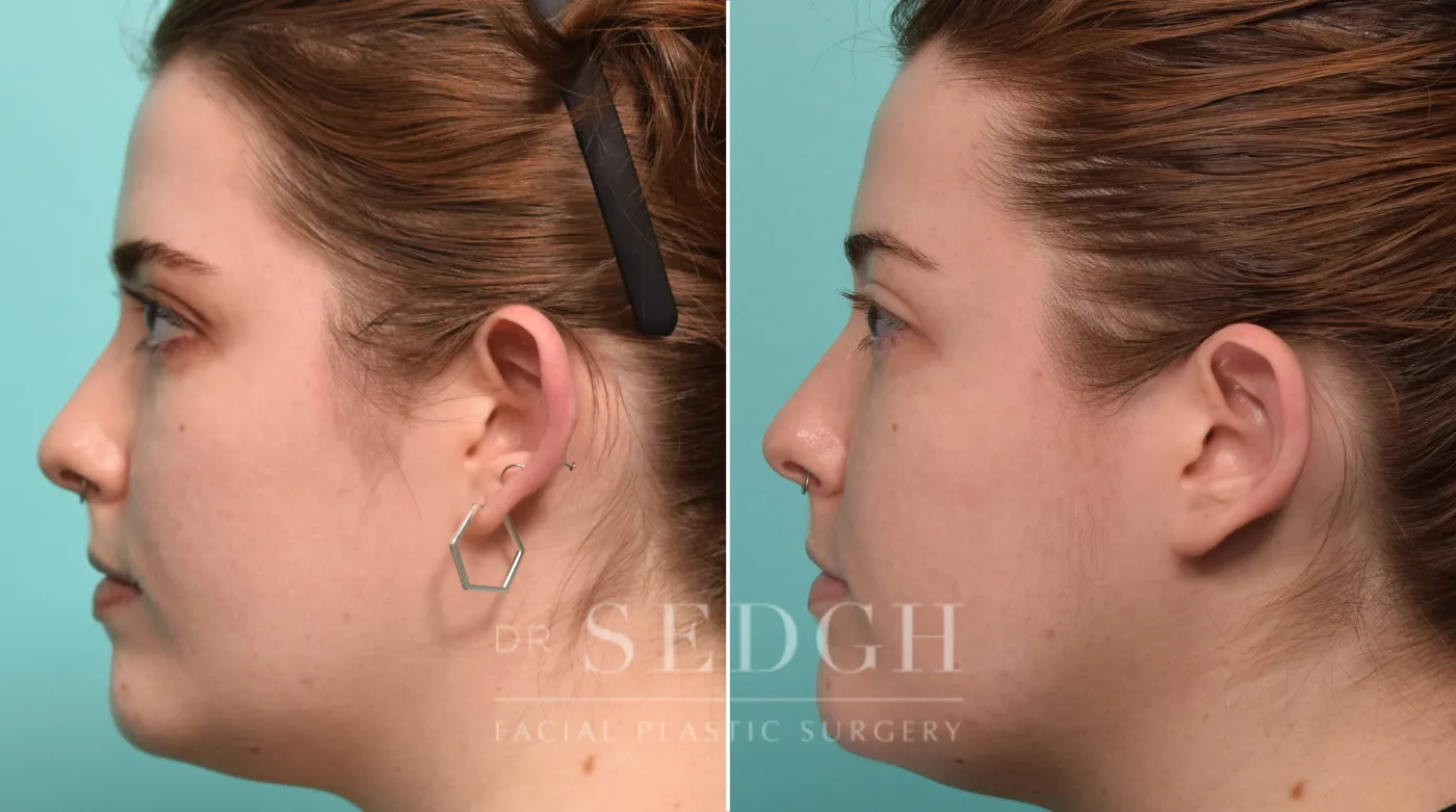 Patient 269 after Ear Pinning Surgery, view 1