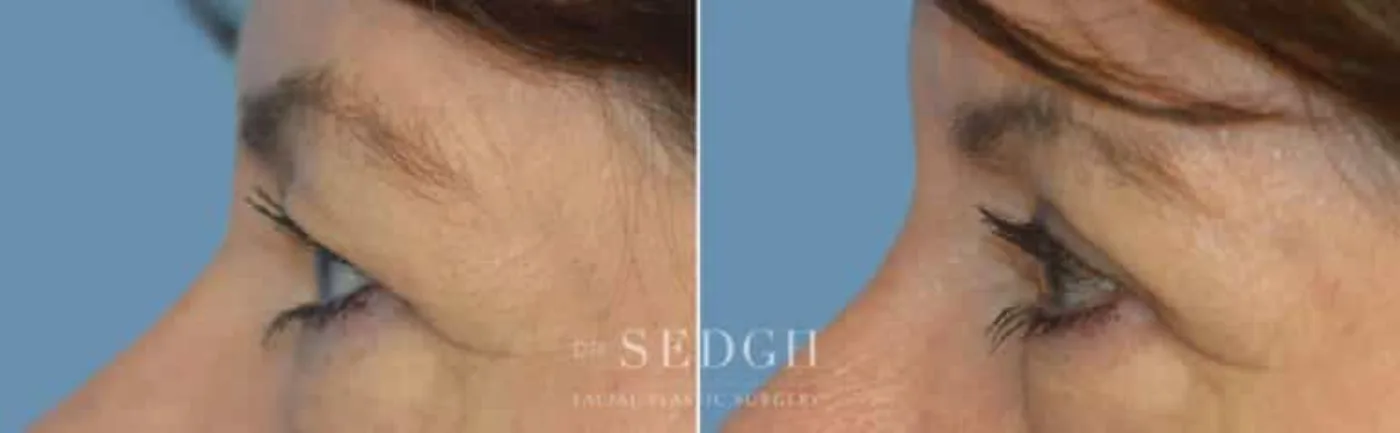 Patient 2 after Upper Blepharoplasty, view 1
