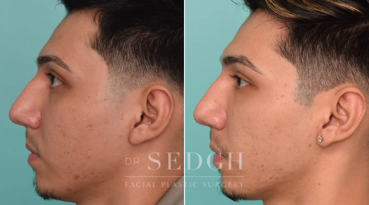 Patient 257 after Ear Pinning Surgery, view 1