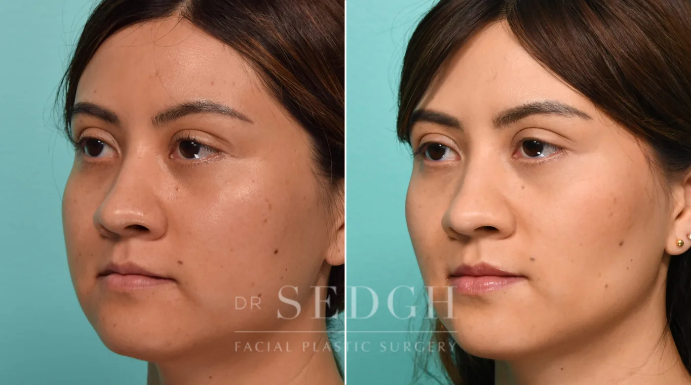 Patient 307 before Buccal Fat Reduction, view 2