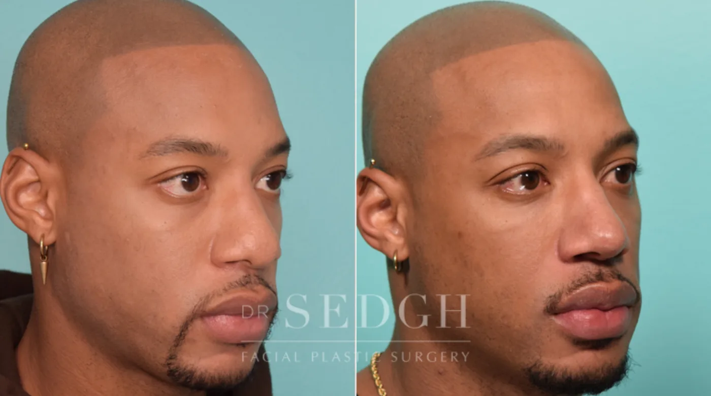 Patient 266 before African American Rhinoplasty, view 2
