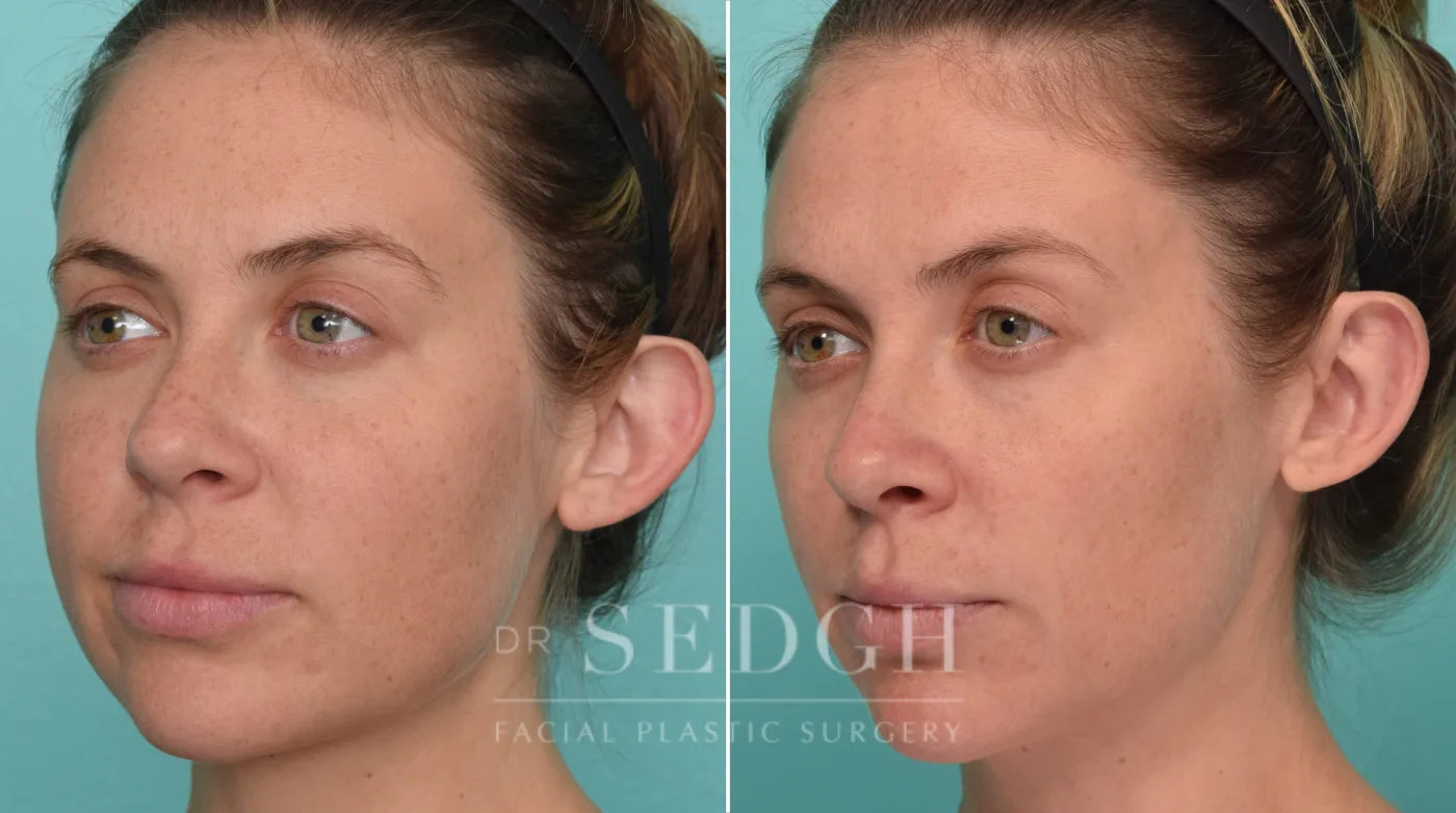 Patient 321 before Ear Pinning Surgery, view 2