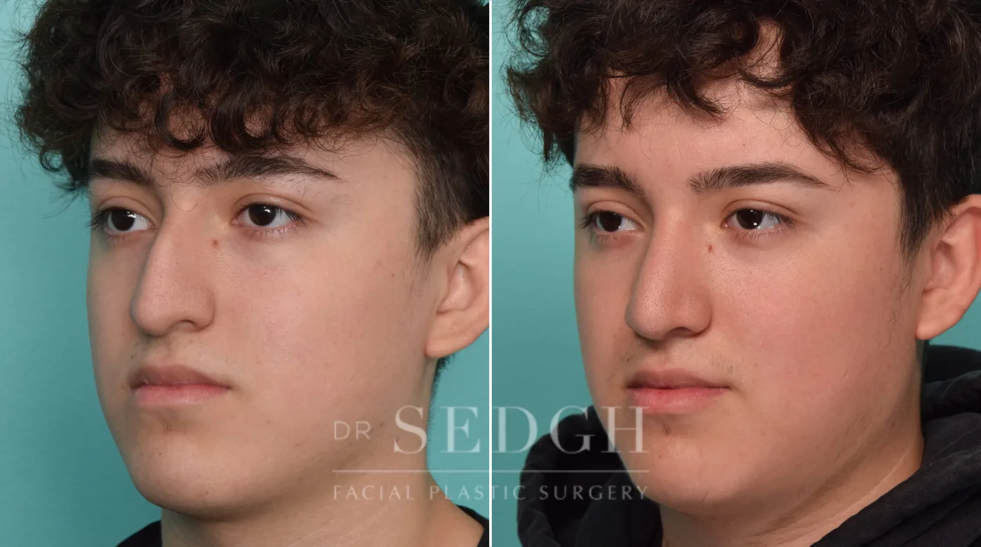 Patient 296 before Rhinoplasty, view 2