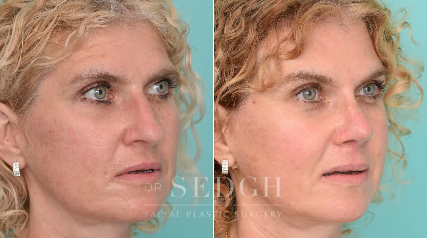 Patient 213 before Brow Lift, view 1