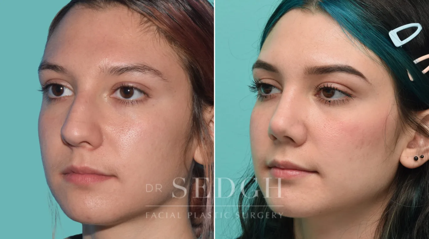 Patient 32 after Rhinoplasty, view 2