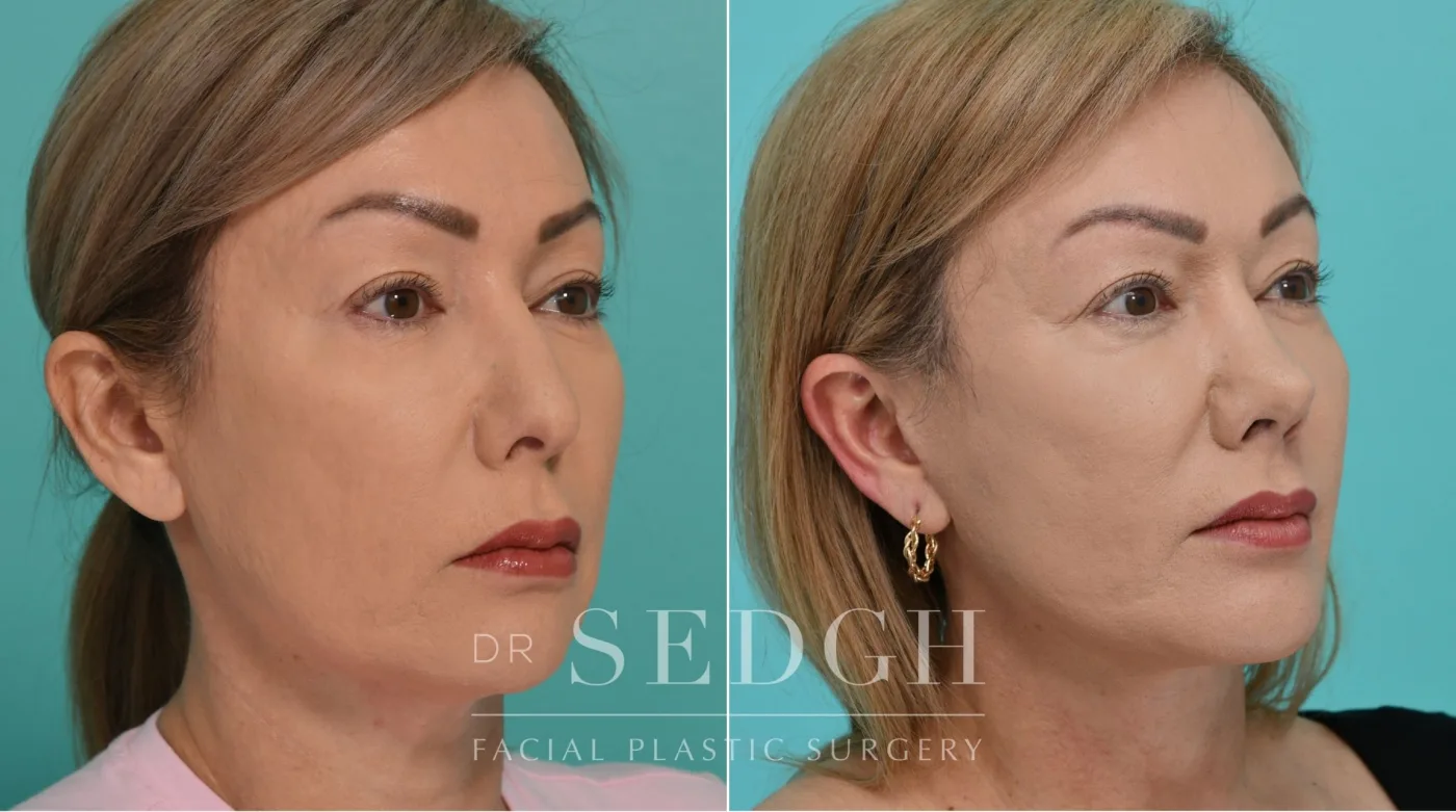 Patient 341 after Face Lift, view 1