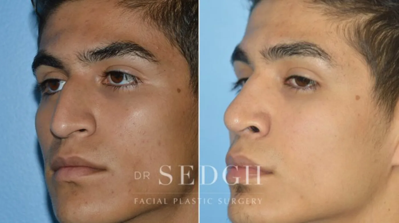 Patient 2 after Hispanic Rhinoplasty, view 1