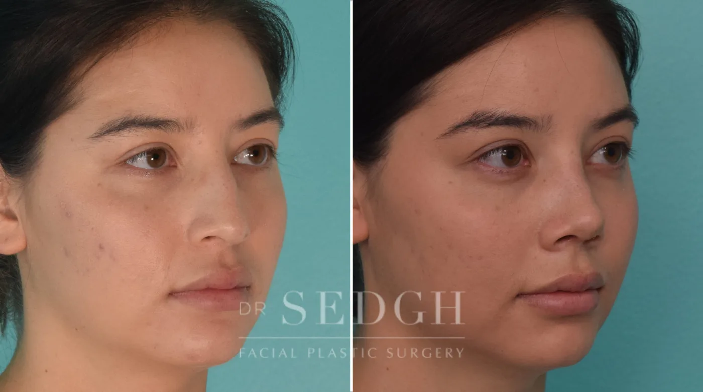 Patient 191 before Female Rhinoplasty, view 2