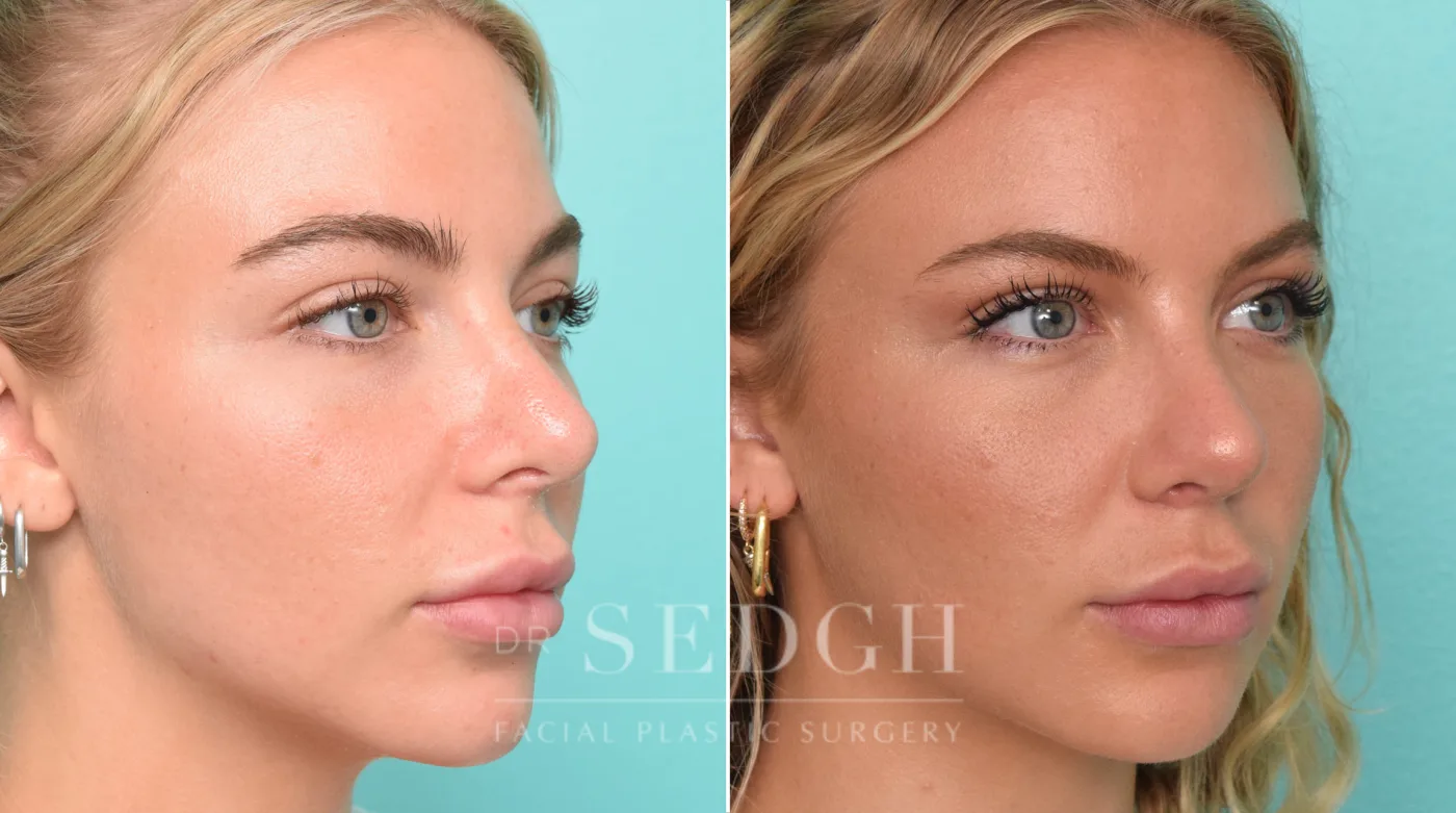 Patient 299 before Revision Rhinoplasty, view 1