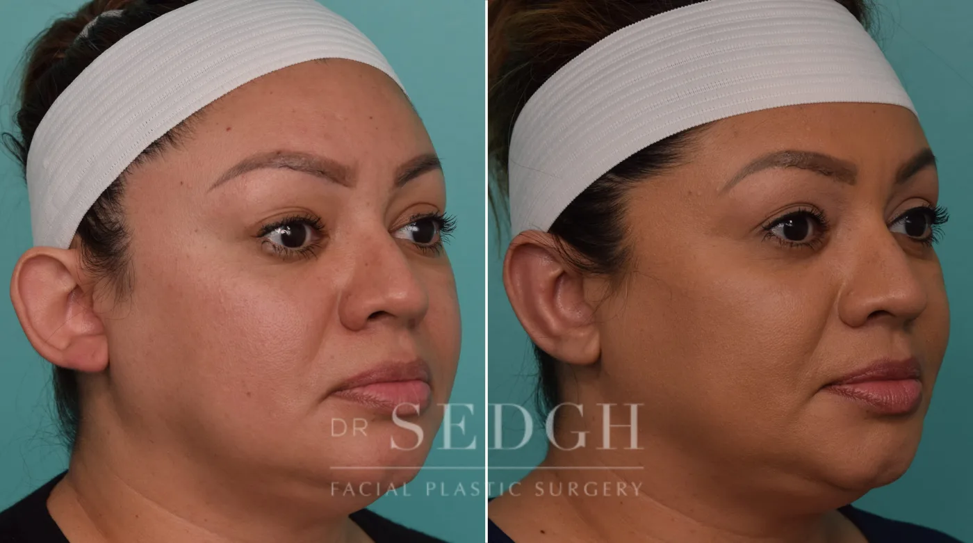 Patient 256 before Ear Pinning Surgery, view 2