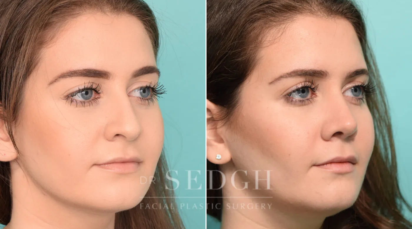 Patient 244 before Rhinoplasty, view 2