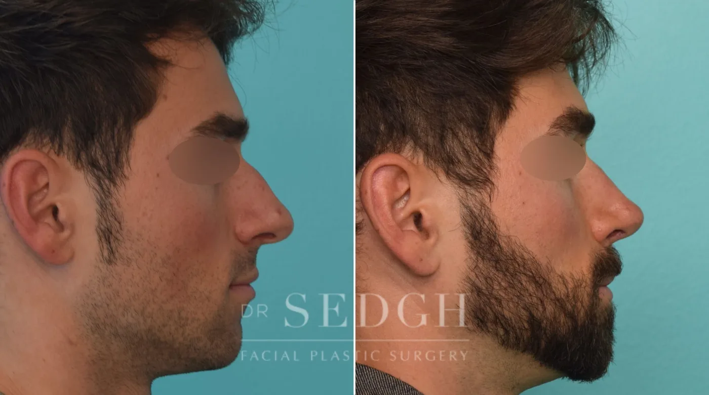 Patient 273 before Male Rhinoplasty, view 3