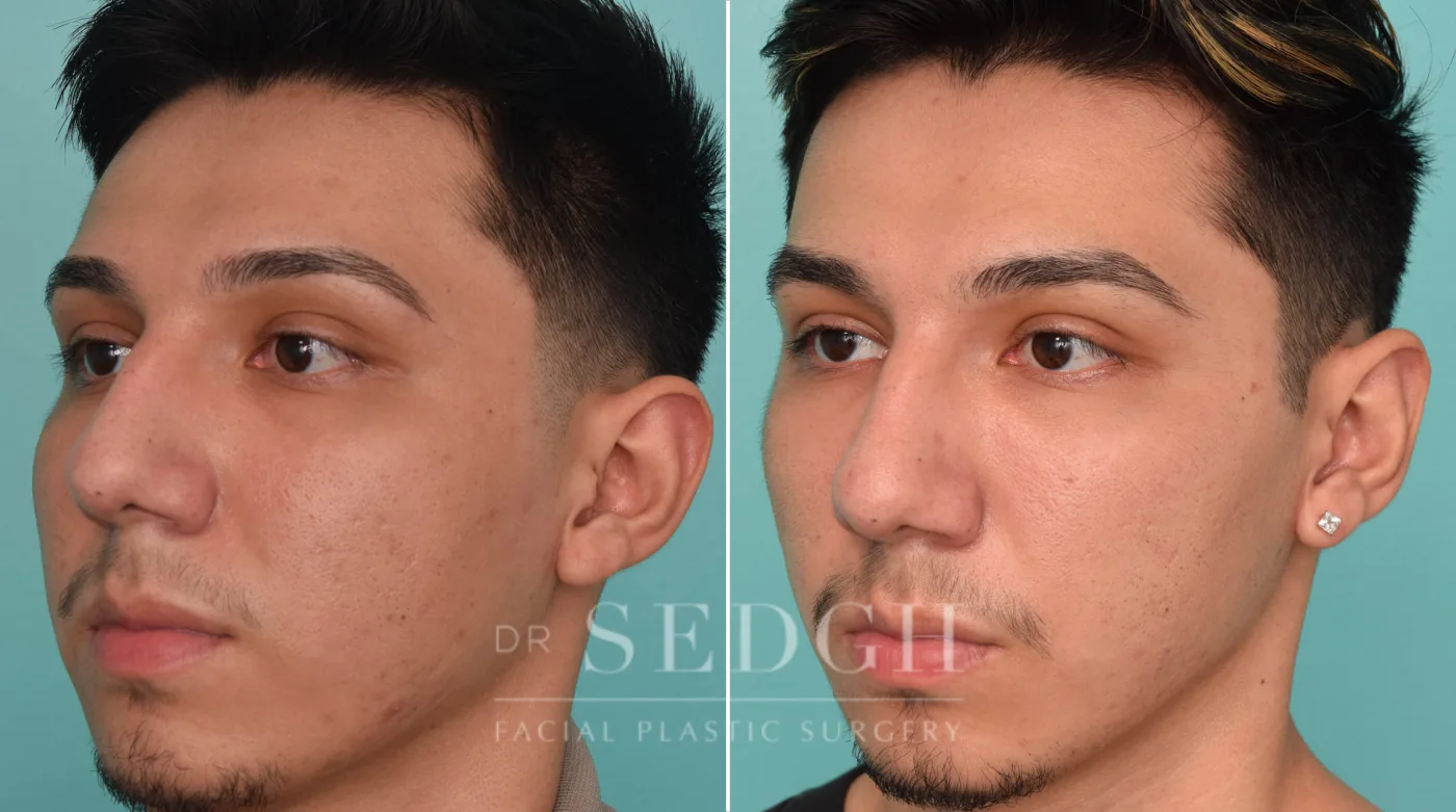 Patient 257 before Ear Pinning Surgery, view 1