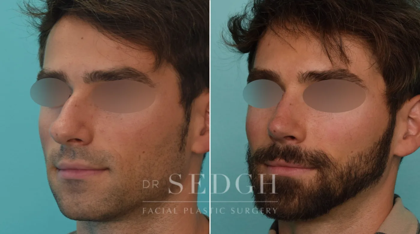 Patient 273 before Male Rhinoplasty, view 1