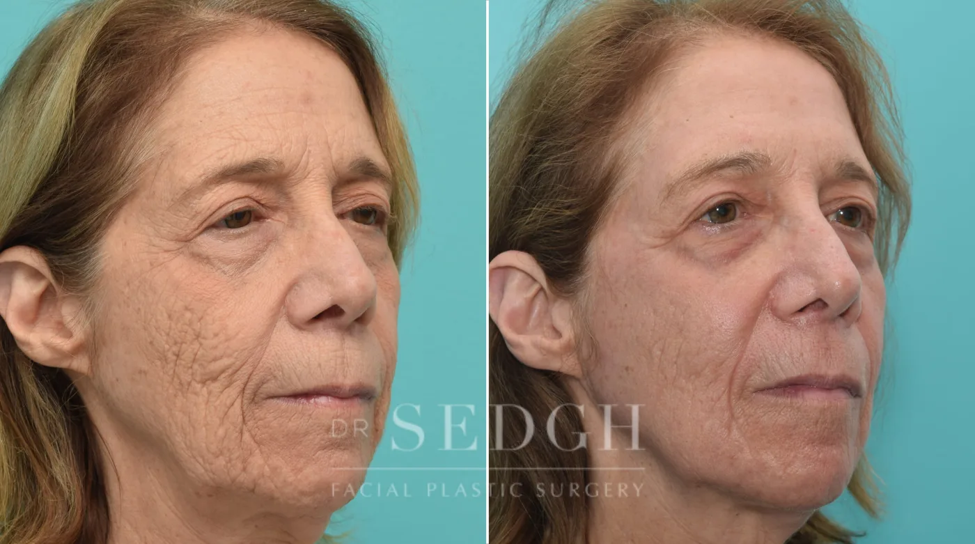 Patient 149 before Laser Skin Treatments, view 1