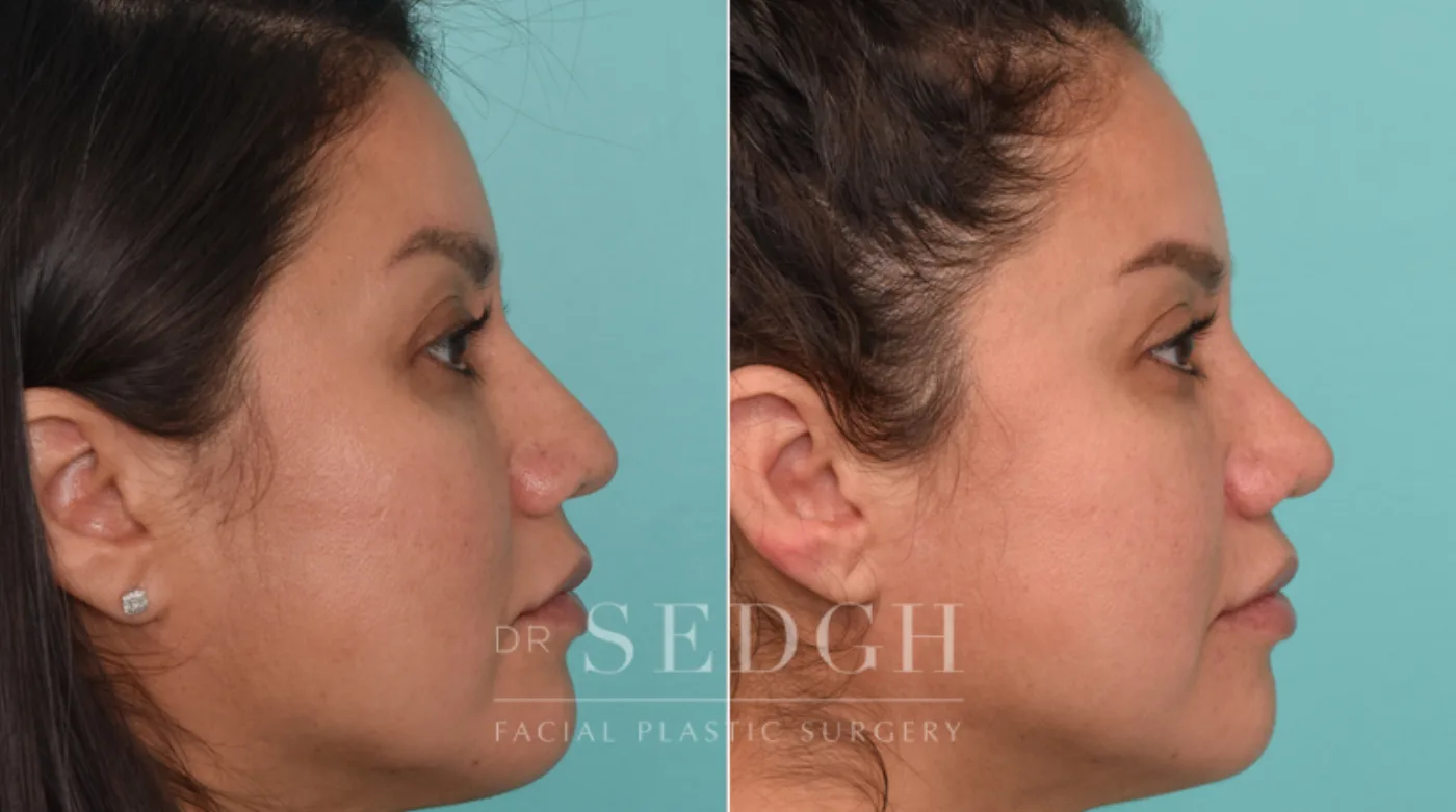 Patient 282 after Hispanic Rhinoplasty, view 2