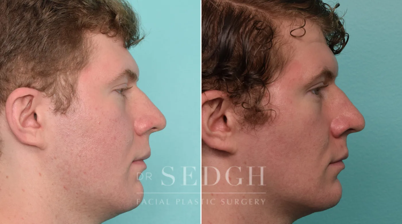 Patient 264 after Buccal Fat Reduction, view 2