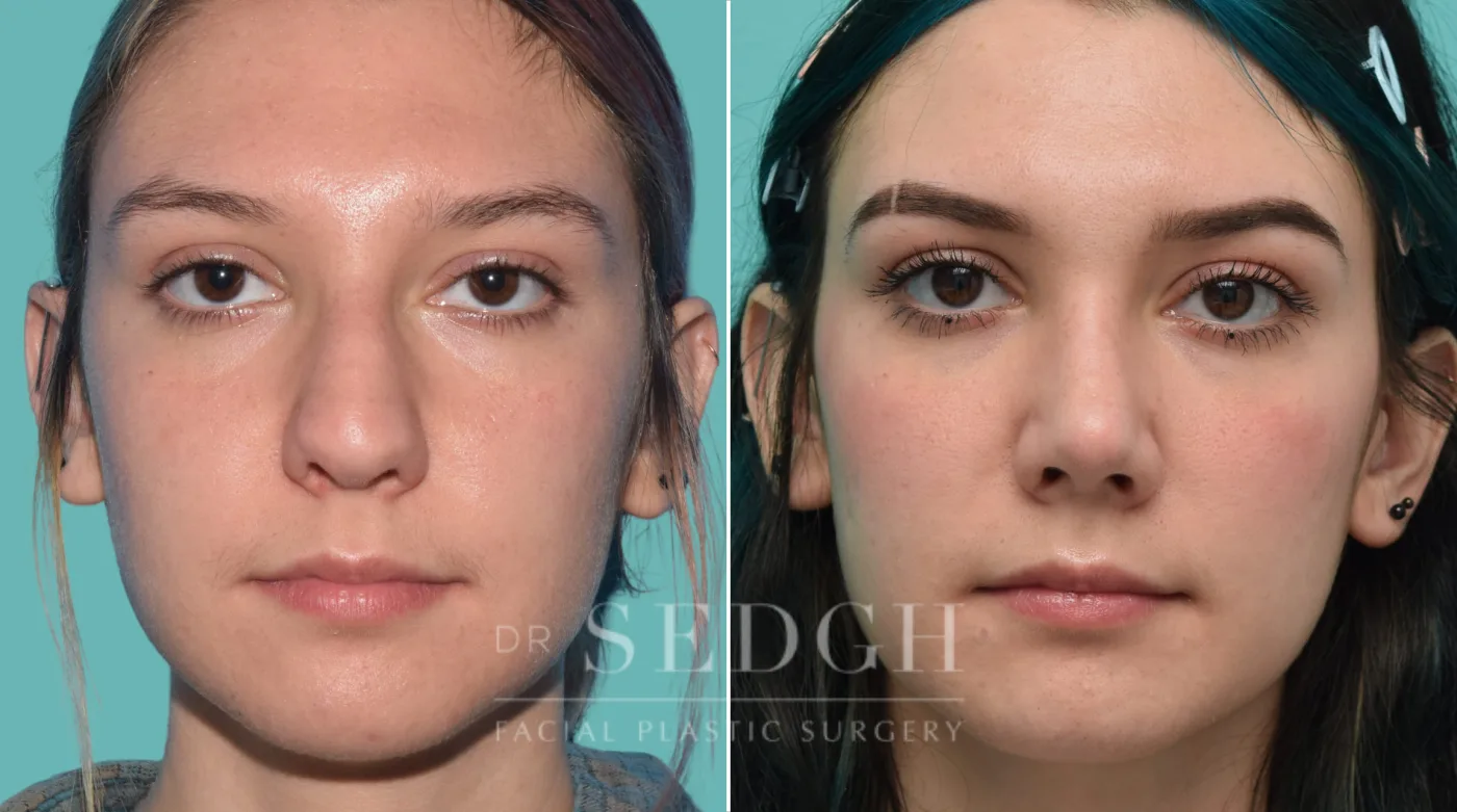 Patient 32 before Rhinoplasty, view 2