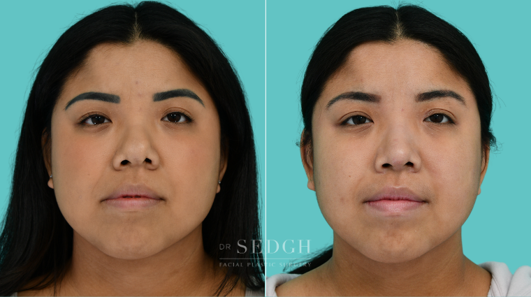 Patient 377 before Asian Rhinoplasty, view 1