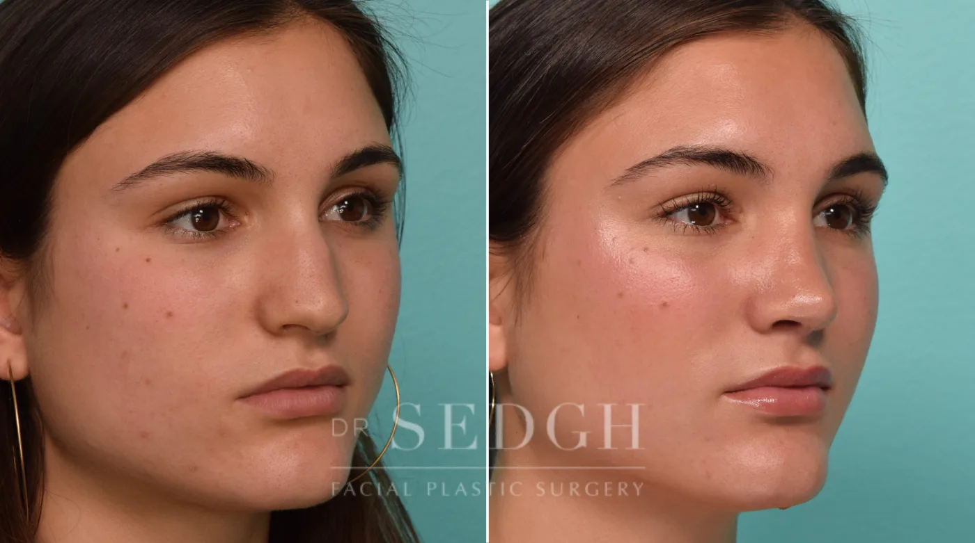 Patient 308 before Rhinoplasty, view 2