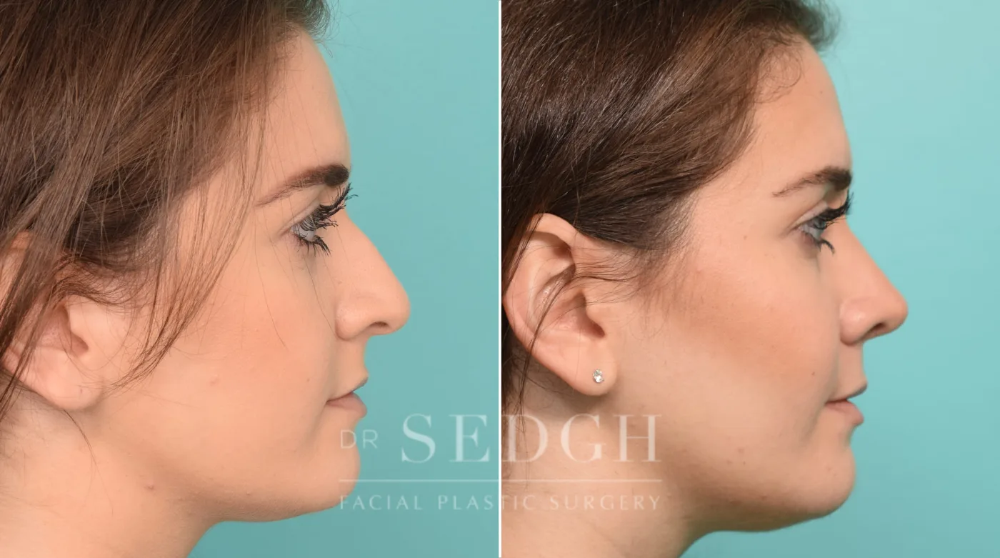 Patient 244 after Rhinoplasty, view 2