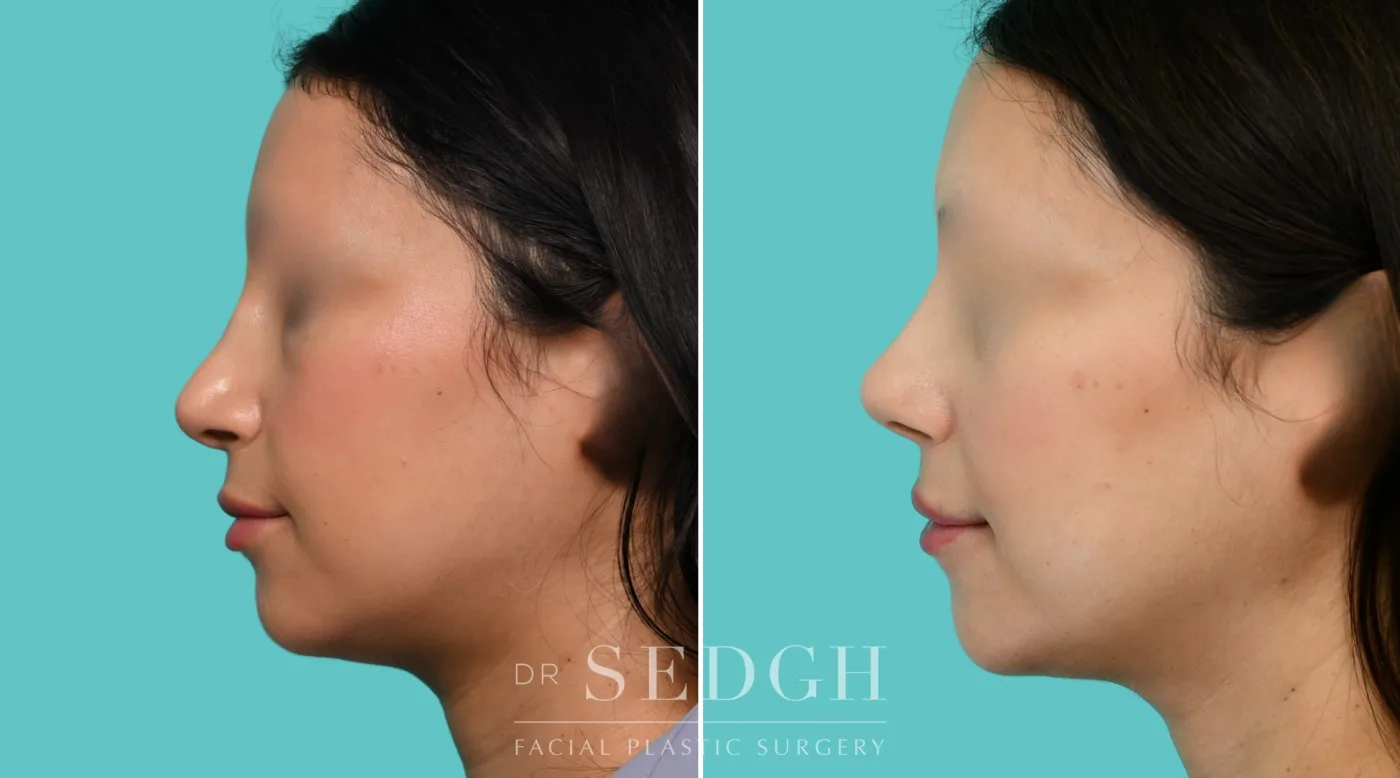 Patient 354 before Revision Rhinoplasty, view 4