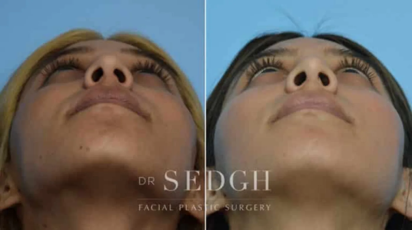 Patient 3 after Hispanic Rhinoplasty, view 1