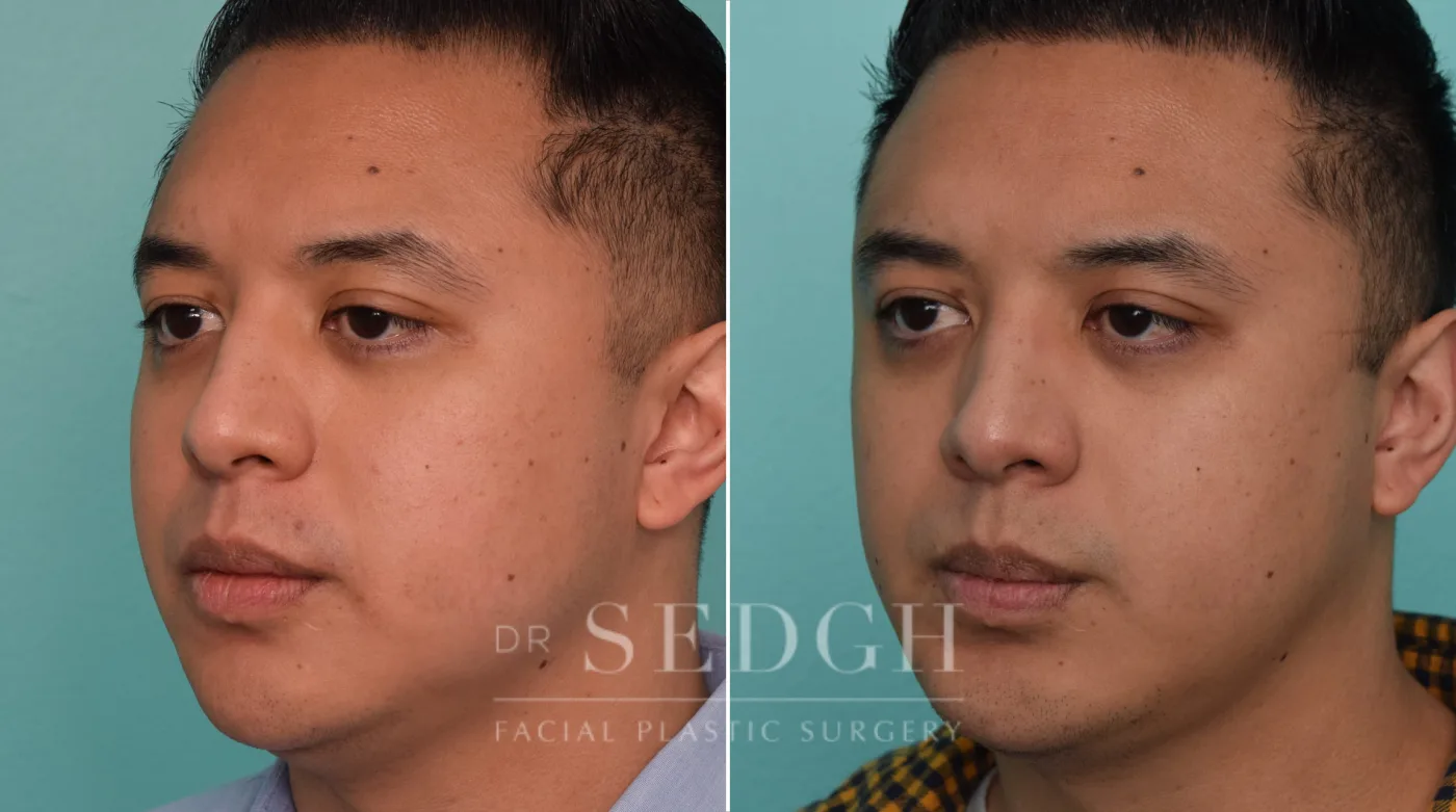 Patient 278 before Chin Augmentation, view 1