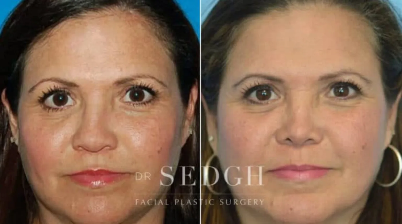 Patient 3 before Crooked Nose Surgery, view 1